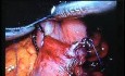 Jejunal Gastrointestinal Stromal tumor (GIST) (51 of 86)