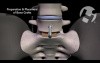 L5-S1 Anterior and Posterior Discectomy and Spinal Fusion