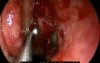 Basic Endoscopic Sinus Surgery