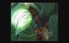 Cardioesophageal Cancer Surgery