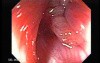 Rectal Adenocarcinoma - Colonoscopy (5 of 8)