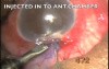 Microtrack filtration of uveitic glaucoma