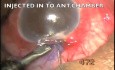 Microtrack filtration of uveitic glaucoma
