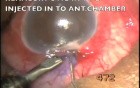 Microtrack filtration of uveitic glaucoma