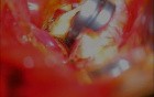 Brain Aneurysm - Posterior Communicating Aretry Aneurysm - Microsurgery