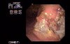 Gastric Adenocarcinoma - Obstruction - Endoscopy