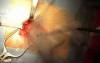 Femoral hernia repair
