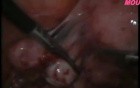 Removal of Peritubal Adhesions Using Laparoscopy