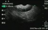 EUS-FNA in diagnosis of IPMT III