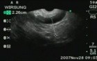 EUS-FNA in diagnosis of IPMT III