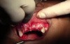 Suturing Technique - Maxillary Bone Grafting #7-8-10 Sites