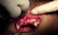Suturing Technique - Maxillary Bone Grafting #7-8-10 Sites