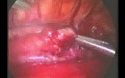 Thoracoscopic repair of esophageal atresia with distal fistula treacheoesophagalis in newborn