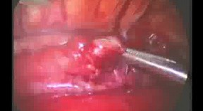 Thoracoscopic repair of esophageal atresia with distal fistula treacheoesophagalis in newborn
