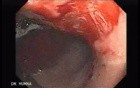 Multiple Gastric Angiodysplasia (15 of 17)