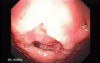 Colonic Interposition for Esophageal Substitution (6 of 11)