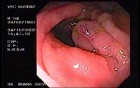 Zollinger- Ellison Syndrome - Gastric Ulcer with Gastrocolic Fistula (2 of 21)