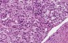 Renal cell carcinoma - Histopathology - Kidney