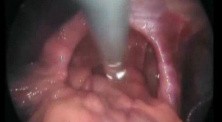 Huge Hiatal Hernia