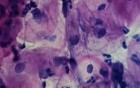 Women - Urethra - Urethritis