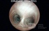 Tracheal Bifurcation