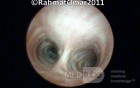 Tracheal Bifurcation