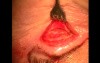 Bloodless entropion surgery