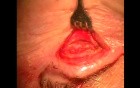Bloodless entropion surgery