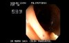 Endoscopic snare excision of large pediculated Polyp (5 of 5)