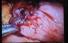 Jejunal Gastrointestinal Stromal tumor (GIST) (70 of 86)