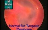 Endoscopic View Of Normal Tympanic Membrane