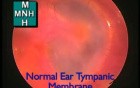 Endoscopic View Of Normal Tympanic Membrane