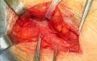 Inguinal hernia repair with mesh
