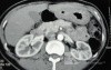 Endoscopy of Scirrhous Gastric Carcinoma involving the entire Fundus, Body and the Antrum (24 of 47)