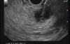 Pancreatic cancer