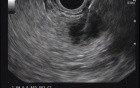 Pancreatic cancer