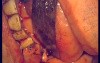 Regeneration Of Multialveolar Process (Right-Side) (3/3)