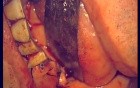 Regeneration Of Multialveolar Process (Right-Side) (3/3)