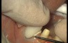 Glass Ionomer Cementation (4/6)