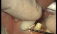 Glass Ionomer Cementation (4/6)