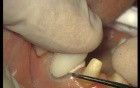 Glass Ionomer Cementation (4/6)