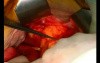Open Right Hemicolectomy – Technical Principles - Operation No 2 - Part 1
