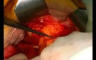 Open Right Hemicolectomy – Technical Principles - Operation No 2 - Part 1