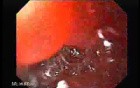 Ileal Neobladder Substitution (ileal bladder) (5 of 9)