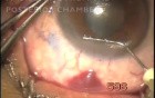 Transconjunctival filtration with bleeding