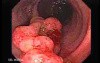 Colonoscopic Polypectomy (2 of 29)