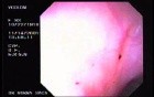 Diverticular Disease - Hemorrhage (15 of 15)