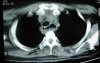 Esophagus - Pneumatic Dilation for Achalasia (28 of 31)