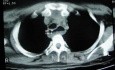 Esophagus - Pneumatic Dilation for Achalasia (28 of 31)