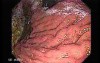 Scirrhous Gastric Carcinoma - Endoscopy (2 of 15)